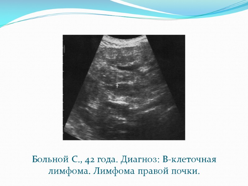 Больной С., 42 года. Диагноз: В-клеточная лимфома. Лимфома правой почки.